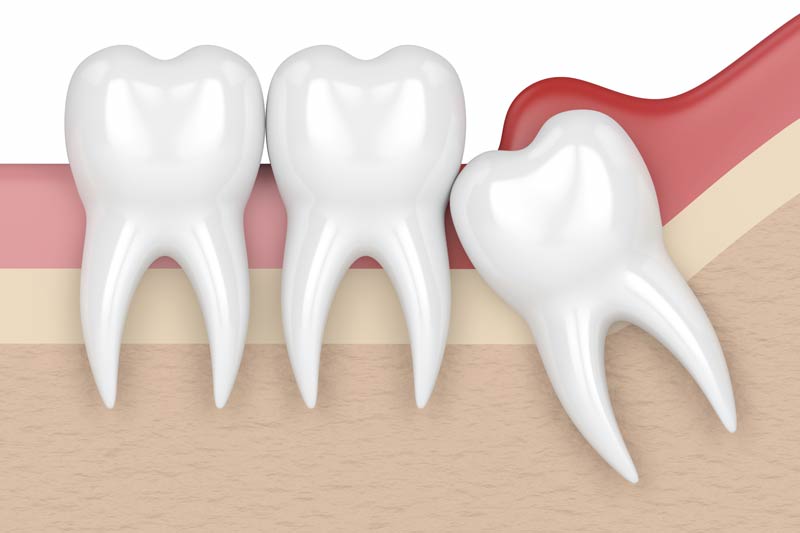 Wisdom Tooth Removal in New Smyrna Beach